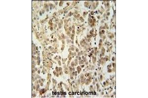 LUZP4 Antibody (N-term) (ABIN654223 and ABIN2844059) immunohistochemistry analysis in formalin fixed and paraffin embedded human testis carcinoma followed by peroxidase conjugation of the secondary antibody and DAB staining. (LUZP4 antibody  (N-Term))