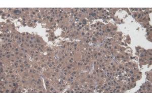 Detection of COL1a2 in Human Liver cancer Tissue using Polyclonal Antibody to Collagen Type I Alpha 2 (COL1a2) (COL1A2 antibody  (AA 1103-1366))