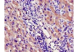 Immunohistochemistry of paraffin-embedded human liver cancer using ABIN7142182 at dilution of 1:100