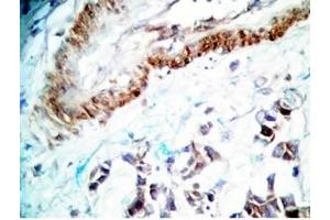 Human stomach cancer tissue was stained by rabbit Anti-Spexin prepro (36-58)  (H) Antiserum (Spexin antibody  (Preproprotein))