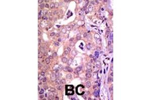 Formalin-fixed and paraffin-embedded human cancer tissue reacted with the primary antibody, which was peroxidase-conjugated to the secondary antibody, followed by AEC staining. (USP1 antibody  (C-Term))