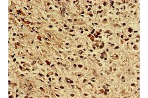 Immunohistochemistry analysis of human glioma using ABIN7176355 at dilution of 1:100 (ZNF529 antibody  (AA 393-563))