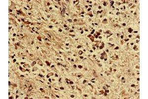 Immunohistochemistry analysis of human glioma using ABIN7176355 at dilution of 1:100