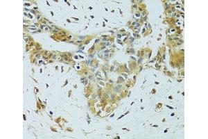 Immunohistochemistry of paraffin-embedded Human breast cancer using METTL13 Polyclonal Antibody at dilution of 1:100 (40x lens). (METTL13 antibody)