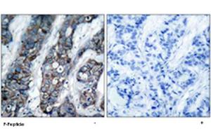 Immunohistochemical analysis of paraffin-embedded human breast carcinoma tissue using ERBB2 (phospho Y1248) polyclonal antibody . (ErbB2/Her2 antibody  (pTyr1248))