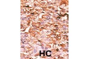 Immunohistochemistry (Formalin/PFA-fixed paraffin-embedded sections) of human hepatocarcinoma with HIST1H3B3 (phospho S10) polyclonal antibody , followed by peroxidase-conjugated secondary antibody and AEC staining.