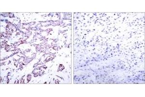 Immunohistochemistry analysis of paraffin-embedded human breast carcinoma, using STAT6 (Phospho-Thr645) Antibody.