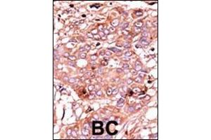 Formalin-fixed and paraffin-embedded human cancer tissue reacted with the primary antibody, which was peroxidase-conjugated to the secondary antibody, followed by AEC staining. (ABL1 antibody  (pTyr251))