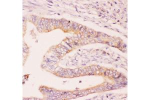 Anti-MCL1 Picoband antibody,  IHC(P): Human Intestinal Cancer Tissue (MCL-1 antibody  (AA 1-350))