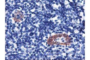 Immunohistochemical staining of paraffin-embedded Human lymphoma tissue using anti-LMCD1 mouse monoclonal antibody. (LMCD1 antibody)