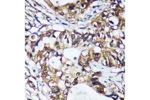 Immunohistochemistry of paraffin-embedded Human colon carcinoma using TSN Rabbit pAb  at dilution of 1:100 (40x lens). (Translin antibody  (AA 50-150))