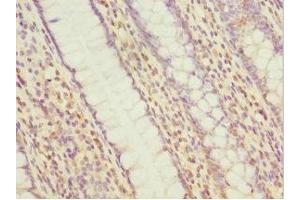 Immunohistochemistry of paraffin-embedded human colon cancer using ABIN7160535 at dilution of 1:100 (MYLK3 antibody  (AA 1-240))