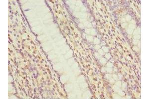 Immunohistochemistry of paraffin-embedded human colon cancer using ABIN7160535 at dilution of 1:100