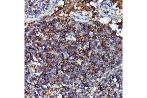 Immunohistochemistry of paraffin-embedded Human anaplastic large cell lymphoma using Human IgM Rabbit mAb (ABIN7267845) at dilution of 1:100 (40x lens). (IGHM antibody)