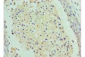 Immunohistochemistry of paraffin-embedded human cervical cancer using ABIN7155341 at dilution of 1:100 (SAP18 antibody  (AA 2-153))