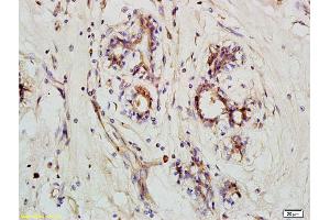 Formalin-fixed and paraffin embedded human breast carcinoma labeled with Anti-NLRX1 Polyclonal Antibody, Unconjugated (ABIN1385925) at 1:200 followed by conjugation to the secondary antibody and DAB staining (NLRX1 antibody  (AA 111-210))
