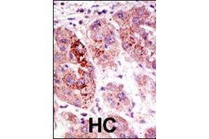Formalin-fixed and paraffin-embedded human cancer tissue reacted with the primary antibody, which was peroxidase-conjugated to the secondary antibody, followed by AEC staining. (USP7 antibody  (C-Term))