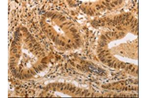 The image on the left is immunohistochemistry of paraffin-embedded Human colon cancer tissue using ABIN7189699(ADRA1B Antibody) at dilution 1/20, on the right is treated with synthetic peptide. (ADRA1B antibody)