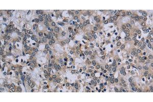 Immunohistochemistry of paraffin-embedded Human liver cancer tissue using TP53AIP1 Polyclonal Antibody at dilution 1:50 (TP53AIP1 antibody)