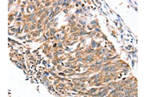 The image on the left is immunohistochemistry of paraffin-embedded Human lung cancer tissue using ABIN7192291(SDC3 Antibody) at dilution 1/30, on the right is treated with synthetic peptide. (SDC3 antibody)