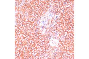 Immunohistochemistry of paraffin-embedded human oophoroma using MOB4 antibody (ABIN6132926, ABIN6143935, ABIN6143936 and ABIN6220703) at dilution of 1:100 (40x lens). (MOBKL3 antibody  (AA 1-225))