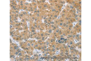 Immunohistochemistry of Human liver cancer using CYP2C9 Polyclonal Antibody at dilution of 1:35 (CYP2C9 antibody)
