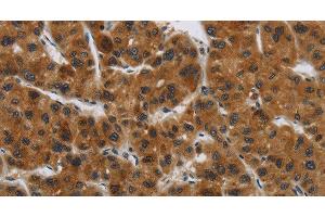 Immunohistochemistry of paraffin-embedded Human liver cancer tissue using GATA5 Polyclonal Antibody at dilution 1:50