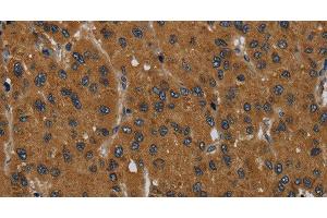 Immunohistochemistry of paraffin-embedded Human liver cancer tissue using MIER2 Polyclonal Antibody at dilution 1:60 (MIER2 antibody)