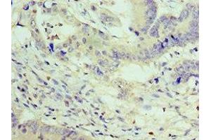 Immunohistochemistry of paraffin-embedded human colon cancer using ABIN7176056 at dilution of 1:100 (ZEB2 antibody  (AA 1050-1214))