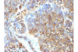 Formalin-fixed, paraffin-embedded human Melanoma stained with Moesin Mouse Monoclonal Antibody (MSN/493). (Moesin antibody)