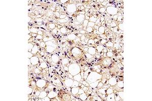 Immunohistochemistry analysis of paraffin embedded human liver cancer using MTHFD1 (ABIN7074609) at dilution of 1: 700 (MTHFD1 antibody)