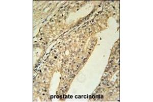 TME Antibody (N-term) (ABIN651651 and ABIN2840344) immunohistochemistry analysis in formalin fixed and paraffin embedded human prostate carcinoma followed by peroxidase conjugation of the secondary antibody and DAB staining.