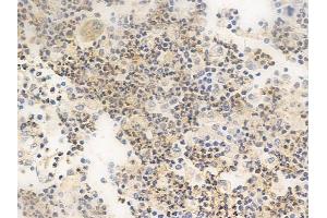 ABIN6265584 and ABIN6266662 at 1/100 staining human colon carcinoma by IHC-P.