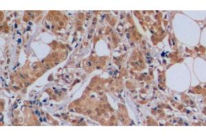 Detection of CDKN1B in Human Breast cancer Tissue using Polyclonal Antibody to Cyclin Dependent Kinase Inhibitor 1B (CDKN1B) (CDKN1B antibody  (AA 1-198))
