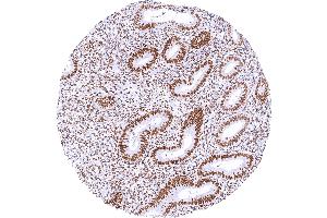 Endometrium with moderate to strong TLE1 staining of epithelial and stromal cells