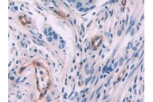 Detection of ENG in Human Colorectal cancer Tissue using Polyclonal Antibody to Endoglin (ENG)
