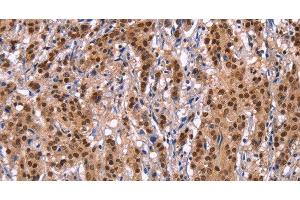 Immunohistochemistry of paraffin-embedded Human gastric cancer tissue using Ephrin A5 Polyclonal Antibody at dilution 1:40