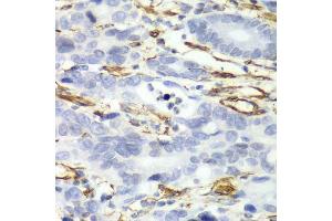 Immunohistochemistry of paraffin-embedded human gastric cancer using CALD1 antibody. (Caldesmon antibody  (AA 1-240))