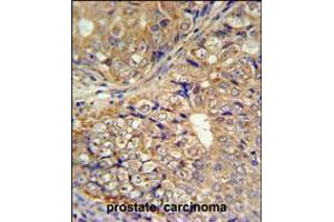 KLHL9 Antibody IHC analysis in formalin fixed and paraffin embedded human prostate carcinoma followed by peroxidase conjugation of the secondary antibody and DAB staining.