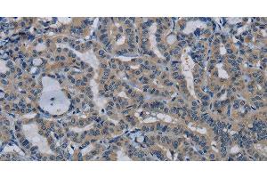 Immunohistochemistry of paraffin-embedded Human thyroid cancer tissue using PIK3CB Polyclonal Antibody at dilution 1:50 (PIK3CB antibody)