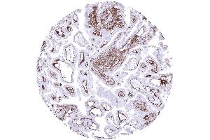 Papillary renal cell carcinoma showing a delicate collagen IV positive membrane between tumor cells and the stroma and an intense staining of vessels (Recombinant Collagen IV antibody)