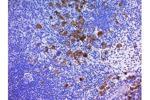Formalin-fixed, paraffin-embedded human Hodgkin's Lymphoma stained with CD30 Monoclonal Antibody (Ber-H2 + CD30/412). (TNFRSF8 antibody)