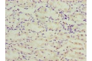 Immunohistochemistry of paraffin-embedded human gastric cancer using ABIN7173269 at dilution of 1:100 (TMEM71 antibody  (AA 1-210))
