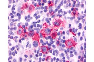 Anti-F2RL3 / PAR4 antibody IHC of human Lymph Node, Hodgkins Lymphoma. (F2RL3 antibody  (Cytoplasmic Domain))