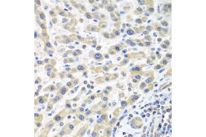 Immunohistochemistry of paraffin-embedded human liver cancer using IL2 antibody at dilution of 1:100 (40x lens).