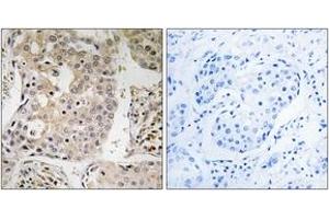 Immunohistochemistry analysis of paraffin-embedded human breast carcinoma tissue, using MRPL41 Antibody. (MRPL41 antibody  (AA 81-130))