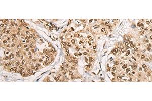 Immunohistochemistry of paraffin-embedded Human prost at e cancer tissue using PHF21A Polyclonal Antibody at dilution of 1:50(x200) (PHF21A antibody)