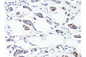 Immunohistochemistry of paraffin-embedded human breast cancer using S100A10 antibody (ABIN6290226) at dilution of 1:100 (40x lens).