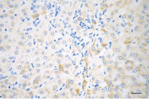 Immunohistochemistry was performed on paraffin-embedded human hepatocarcinoma using BCKDK antibody (ABIN7797783), 1:200). (BCKDK antibody)