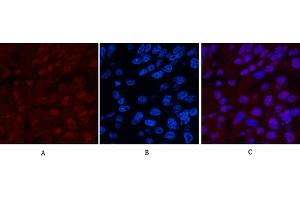 Immunofluorescence analysis of human liver cancer tissue. (XRCC4 antibody)